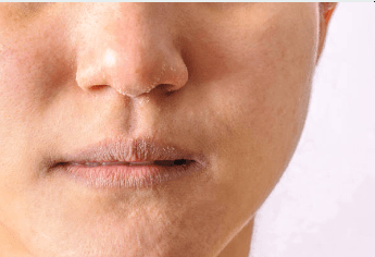 Dealing With Dry Skin