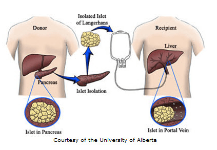 Islet Transplantation and Beta Cell Replacement