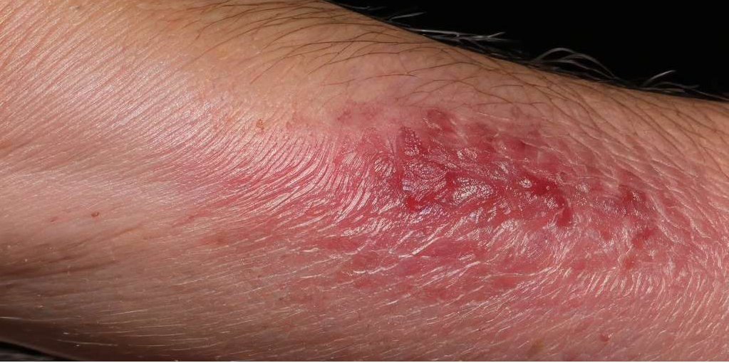 Itchy Skin Relief